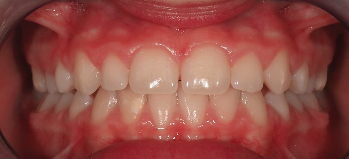 Dopo – Giulia: morso profondo con diastema interincisivo superiore, paziente di 7 anni