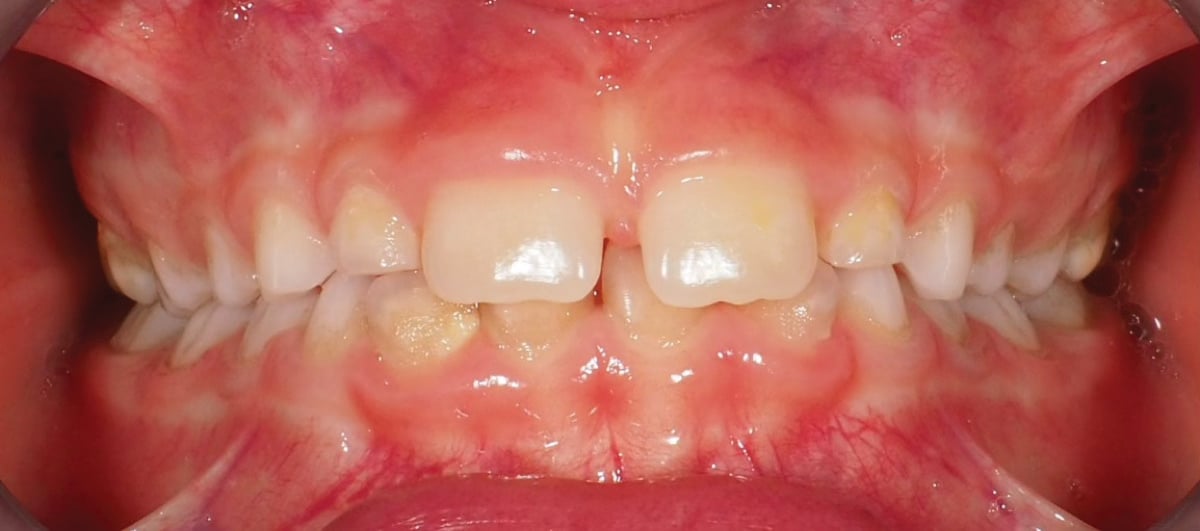 Prima – Giulia: morso profondo con diastema interincisivo superiore, paziente di 7 anni