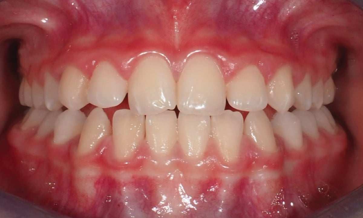 Dopo – Anita: morso aperto con affollamento dentale in dentizione mista, paziente di 8 anni