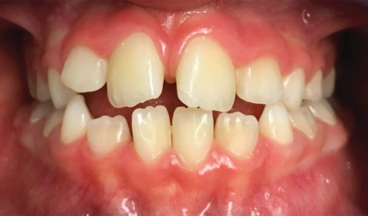 Prima – Anita: morso aperto con affollamento dentale in dentizione mista, paziente di 8 anni