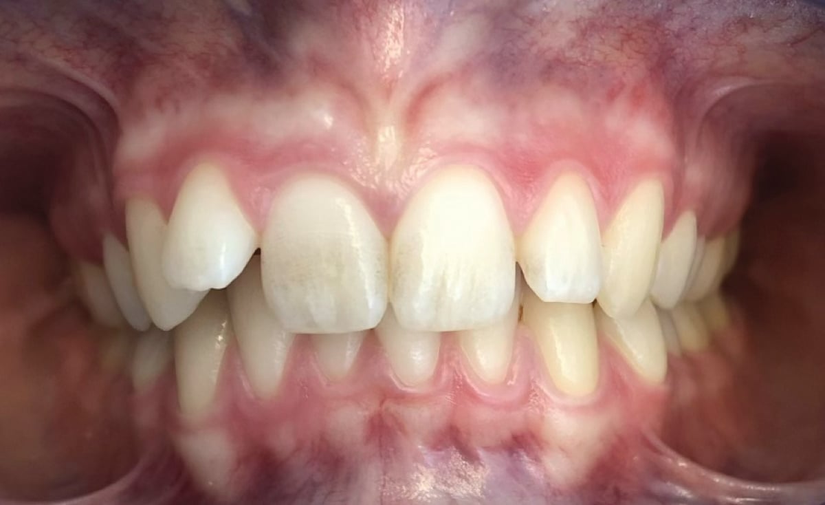 Prima – Joel: malocclusione di II Classe con morso profondo, paziente di 15 anni
